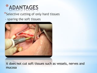 * 
*Selective cutting of only hard tissues 
- sparing the soft tissues 
it does not cut soft tissues such as vessels, nerves and 
mucosa 
 