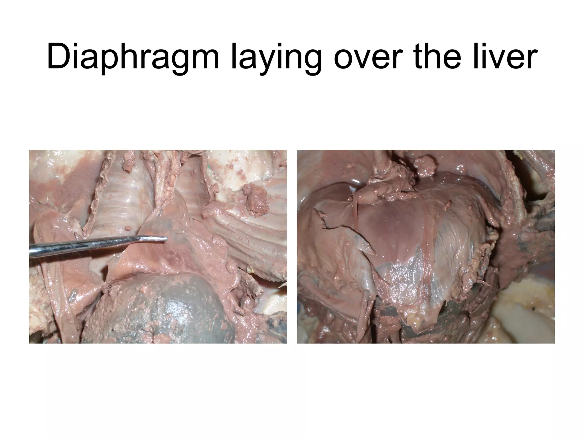 Diaphragm laying over the liver
 