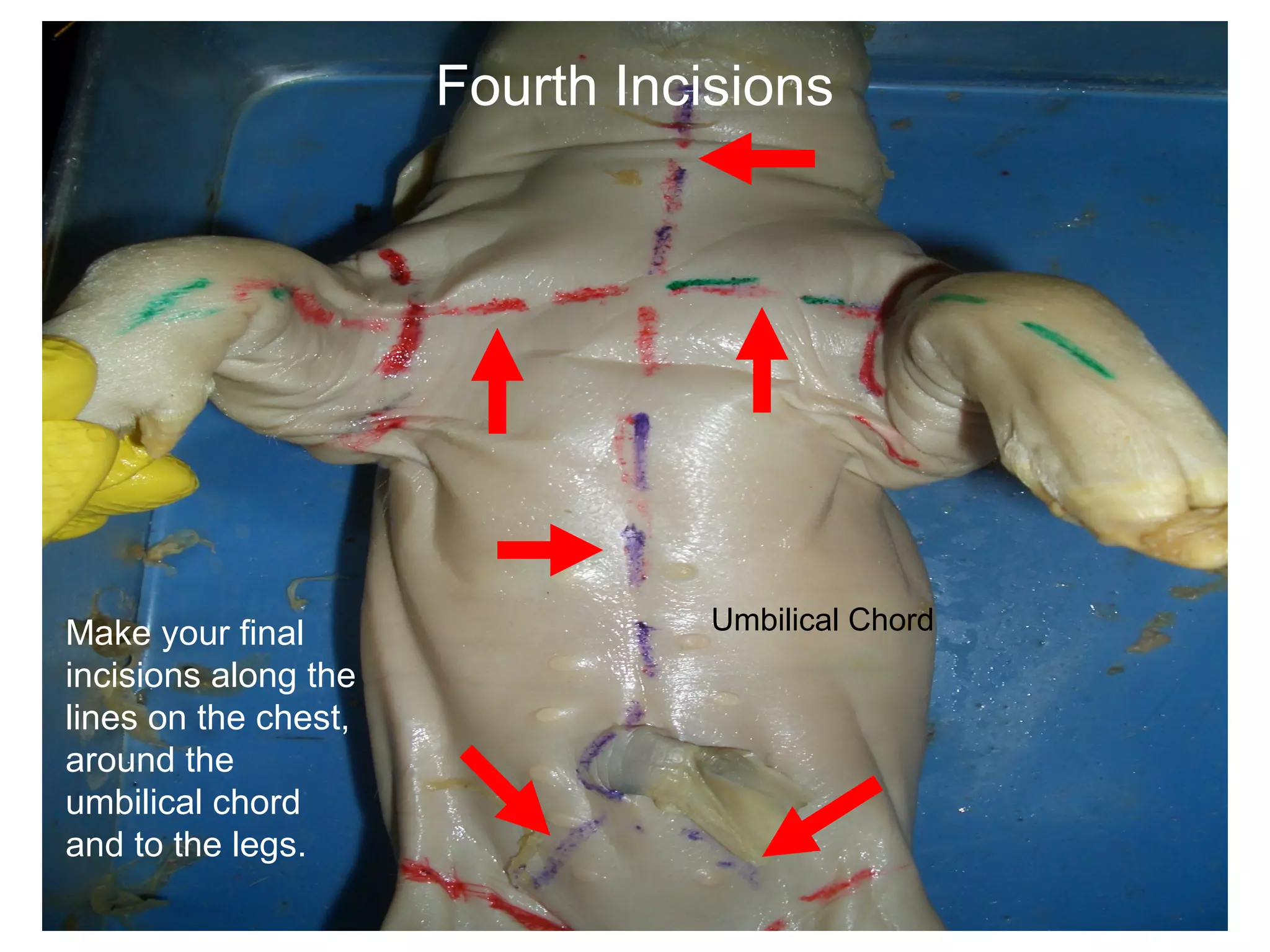 Fourth Incisions
Make your final
incisions along the
lines on the chest,
around the
umbilical chord
and to the legs.
Umbilical Chord
 