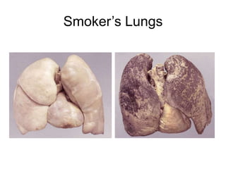 Smoker’s Lungs
 