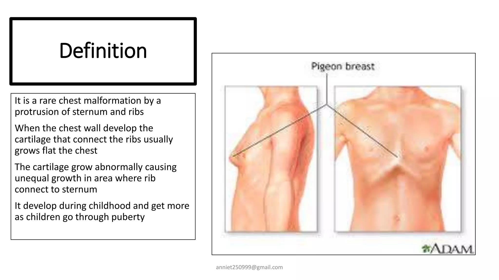 Protruding Chest Bone