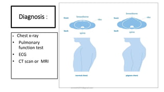 Diagnosis :
 Chest x-ray
• Pulmonary
function test
• ECG
• CT scan or MRI
anniet250999@gmail.com
 