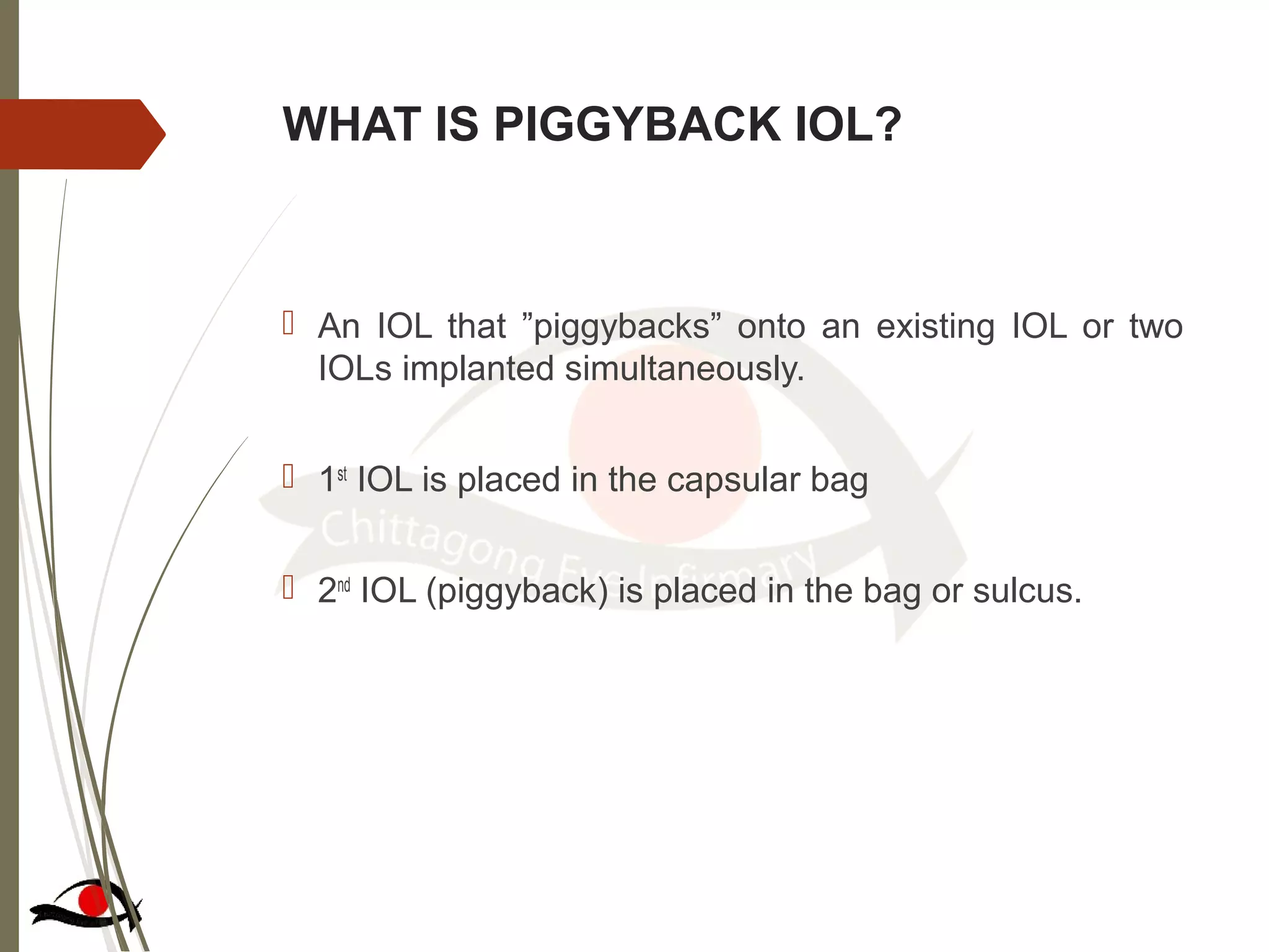 WHAT IS PIGGYBACK IOL?
 An IOL that ”piggybacks” onto an existing IOL or two
IOLs implanted simultaneously.
 1st
IOL is placed in the capsular bag
 2nd
IOL (piggyback) is placed in the bag or sulcus.
 