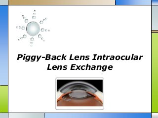 Piggy-Back Lens Intraocular
Lens Exchange
 