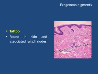 Exogenous pigments
• Tattoo
• Found in skin and
associated lymph nodes
• .
 