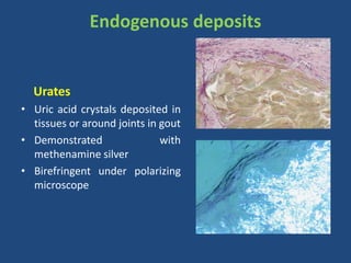 Endogenous deposits
Urates
• Uric acid crystals deposited in
tissues or around joints in gout
• Demonstrated with
methenamine silver
• Birefringent under polarizing
microscope
• .
 