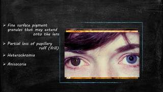Pupillary Ruff Loss Pigmentary glaucoma - Dr Shylesh B Dabke | PPTX