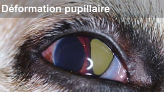Déformation pupillaire 
 