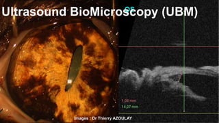 Ultrasound BioMicroscopy (UBM) 
Images : Dr Thierry AZOULAY 
 
