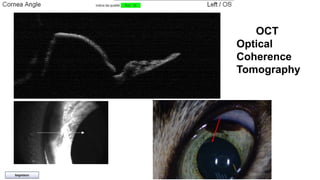 OCT 
Optical 
Coherence 
Tomography 
 