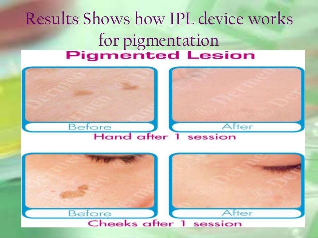 ipl pigmentation removal device how ipl works