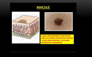 oral melanotic macule slideshare Pigmentations of the oral cavity