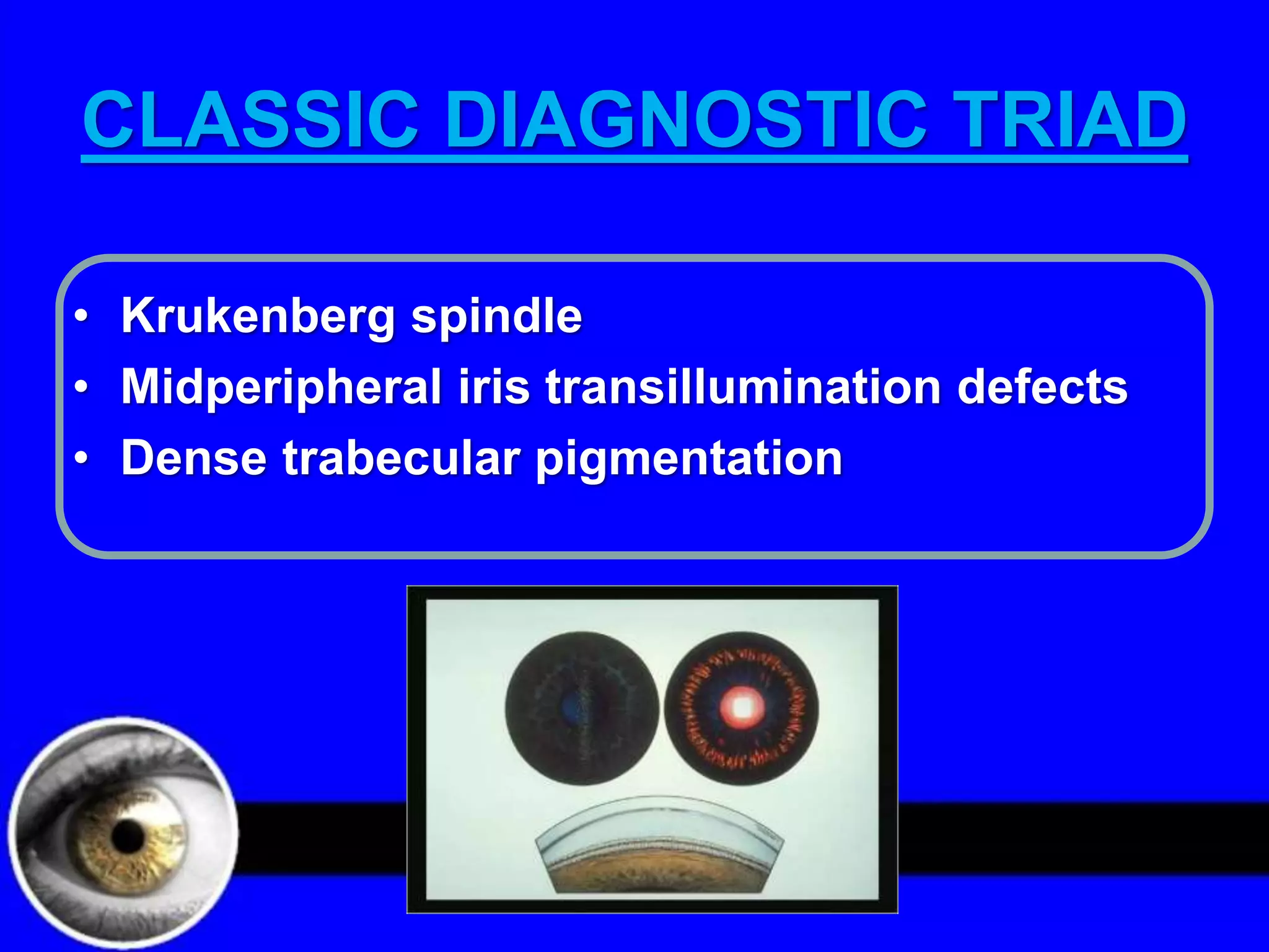 Pigment dispersion syndrome | PPTX