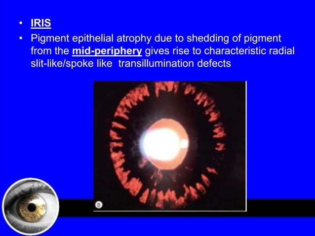 Pigment dispersion syndrome | PPTX | Eye and Vision Conditions ...