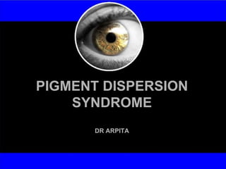 PIGMENT DISPERSION
SYNDROME
DR ARPITA
 
