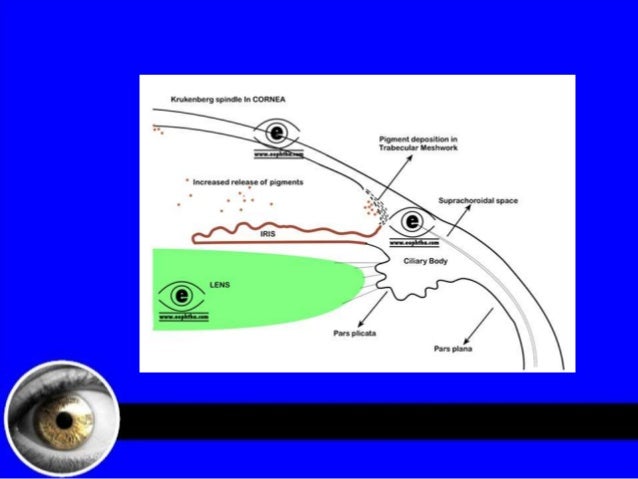 Pigment dispersion syndrome glaucoma diagram 