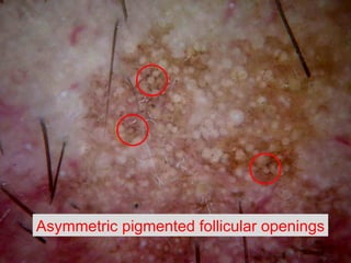 Asymmetric pigmented follicular openings 
