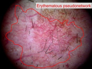 E rythematous pseudonetwork 