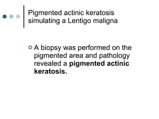 Pigmented actinic keratosis simulating a Lentigo maligna A biopsy was performed on the pigmented area and pathology revealed a  pigmented actinic keratosis. 
