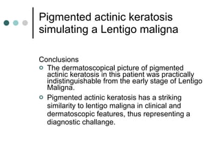 Pigmented actinic keratosis simulating a Lentigo maligna Conclusions The dermatoscopical picture of pigmented actinic keratosis in this patient was practically indistinguishable from the early stage of Lentigo Maligna.  Pigmented actinic keratosis has a striking similarity to lentigo maligna in clinical and dermatoscopic features, thus representing a diagnostic challange.  