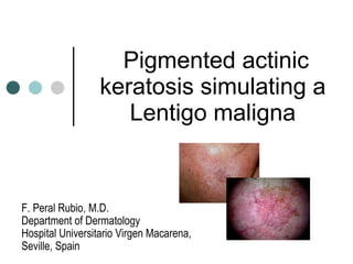   Pigmented actinic keratosis simulating a Lentigo maligna . F. Peral Rubio, M.D. Department of Dermatology  Hospital Universitario Virgen Macarena,  Seville, Spain 