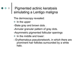   Pigmented actinic keratosis simulating a Lentigo maligna The dermoscopy revealed: In the upper -Slate gray and brown dots . -Annular granular pattern  of gray dots. - Asymmetric pigmented follicular openings In the middle and lower: - E rythematous pseudonetwork, in which there are prominent hair follicles surrounded by a white halo. 