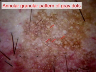 Annular granular pattern  of gray dots 