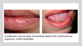pigmented lesion of oral cavity Assadawy.pptx