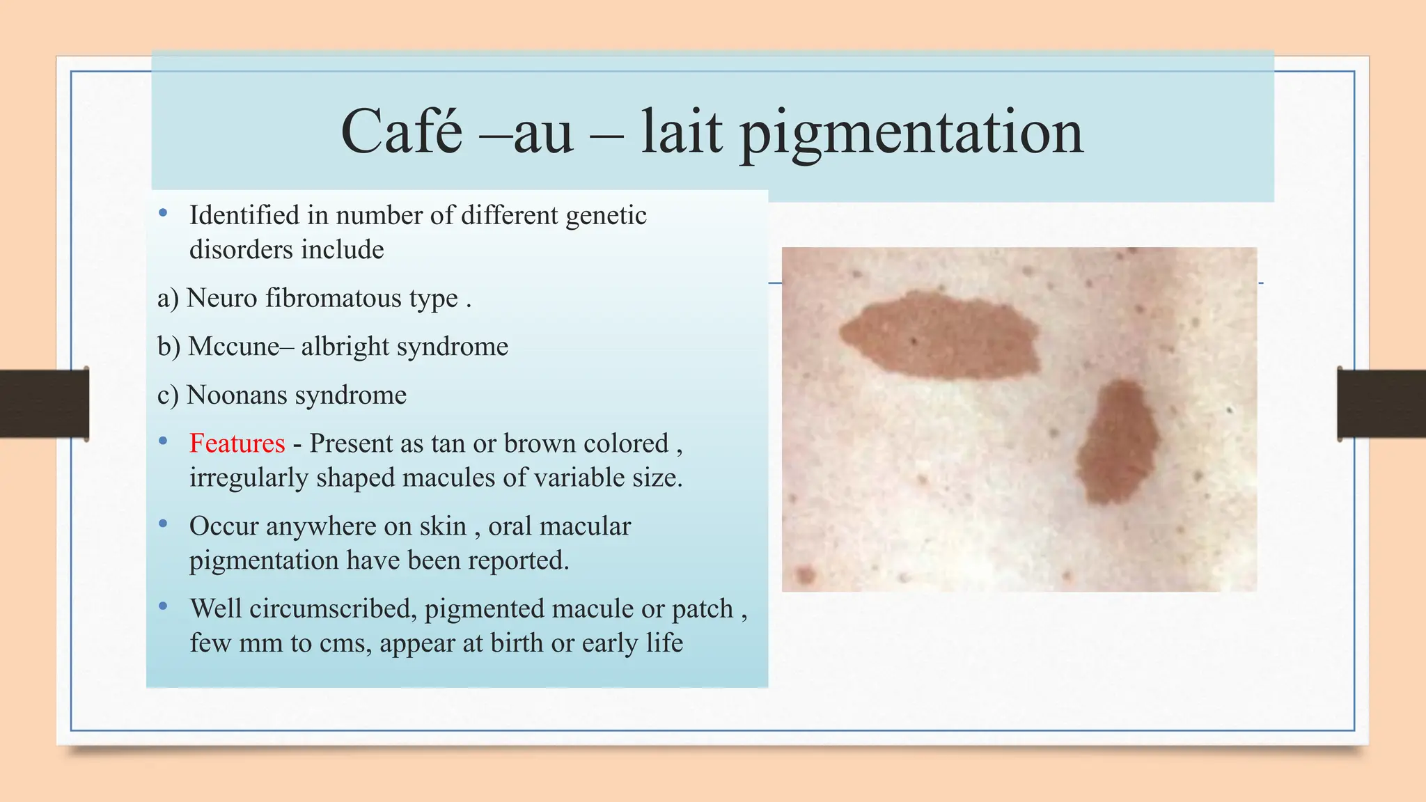 oral melanotic macule slideshare Pigmented lesion of oral mucosa.pptx- DR PRIYANKA