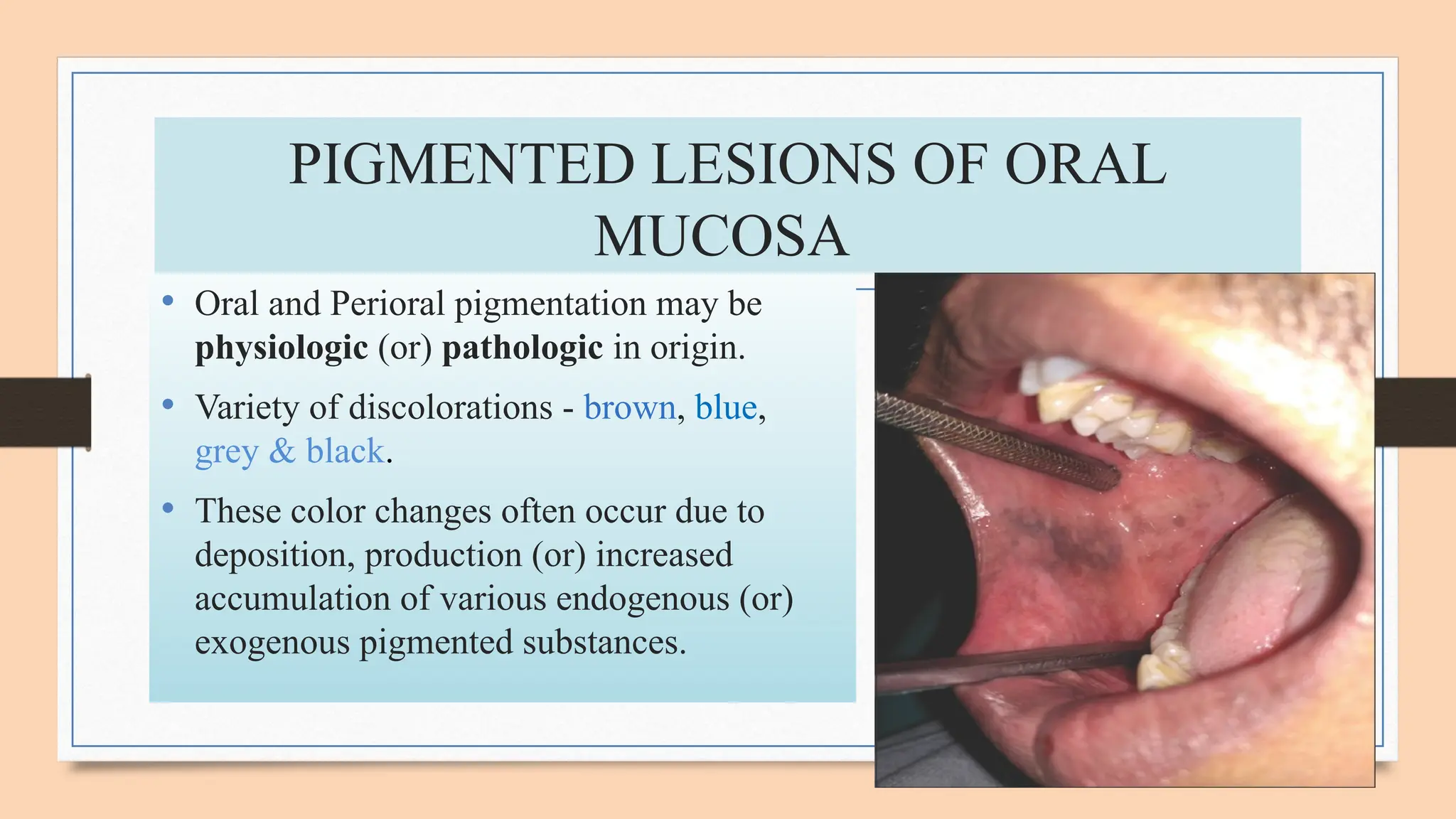oral melanotic macule ppt Pigmented lesion of oral mucosa.pptx- DR PRIYANKA