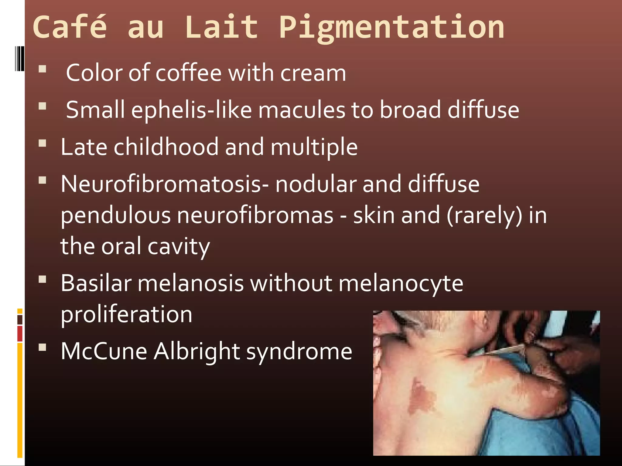 oral melanotic macule slideshare Pigmented lesions