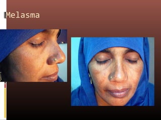 Melasma
 