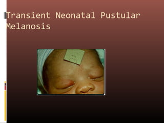 Transient Neonatal Pustular
Melanosis
 