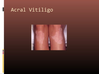 Acral Vitiligo
 