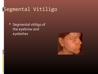 Segmental Vitiligo

  Segmental vitiligo of
   the eyebrow and
   eyelashes
 