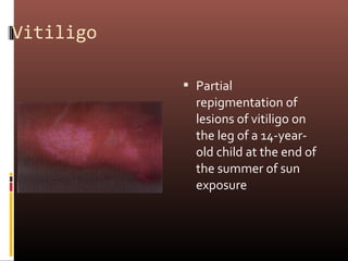 Vitiligo

            Partial
             repigmentation of
             lesions of vitiligo on
             the leg of a 14-year-
             old child at the end of
             the summer of sun
             exposure
 