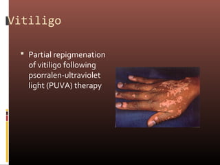 Vitiligo

  Partial repigmenation
   of vitiligo following
   psorralen-ultraviolet
   light (PUVA) therapy
 