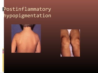 Postinflammatory
hypopigmentation
 