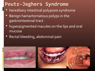 Peutz-Jeghers Syndrome
 hereditary intestinal polyposis syndrome
 Benign hamartomatous polyps in the
  gastrointestinal tract
 hyperpigmented macules on the lips and oral
  mucosa
 Rectal bleeding, abdominal pain
 