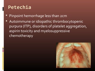Petechia
 Pinpoint hemorrhage less than 2cm
 Autoimmune or idiopathic thrombocytopenic
 purpura (ITP), disorders of platelet aggregation,
 aspirin toxicity and myelosuppressive
 chemotherapy
 