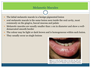 melanotic macule causes Pigmented lesions of oral cavity