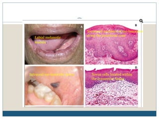 will l-carnitine help with weight loss Primary Malignant Melanoma of the Mandible: A Diagnostic Dilemma and  Surgical Management of a Rare Entity main image 1