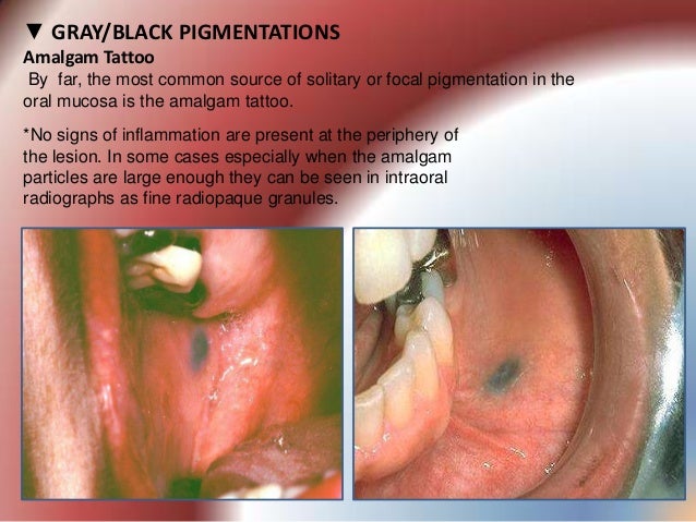 pigmented lesions of oral mucosa pigmented lesions of oral mucosa