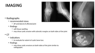 Pvns Rash Pigmented Villonodular Synovitis (PVNS).pptx
