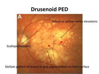 Drusenoid PED
Yellow or yellow–white elevations
Scalloped borders
Stellate pattern of brown or gray pigmentation on their surface
 