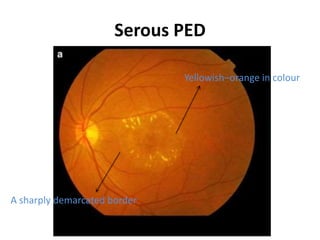 Serous PED
Yellowish–orange in colour
A sharply demarcated border
 