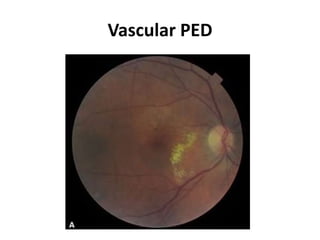 Vascular PED
 