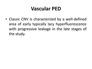 Vascular PED
• Classic CNV is characterized by a well-defined
area of early typically lacy hyperfluorescence
with progressive leakage in the late stages of
the study.
 