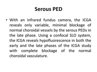 Serous PED
• With an infrared fundus camera, the ICGA
reveals only variable, minimal blockage of
normal choroidal vessels by the serous PEDs in
the late phase. Using a confocal SLO system,
the ICGA reveals hypofluorescence in both the
early and the late phases of the ICGA study
with complete blockage of the normal
choroidal vasculature.
 