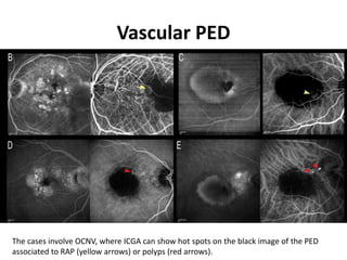 Vascular PED
The cases involve OCNV, where ICGA can show hot spots on the black image of the PED
associated to RAP (yellow arrows) or polyps (red arrows).
 